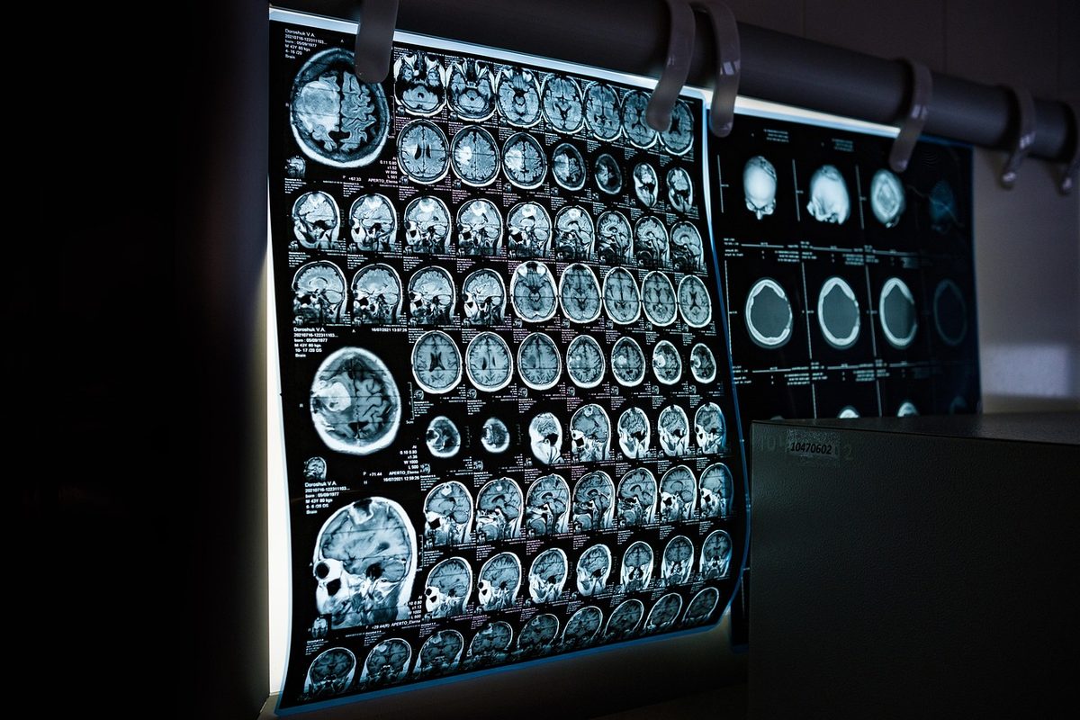 뇌 MRI 영상을 살펴보는 의사, 정밀검사와 특화 검진