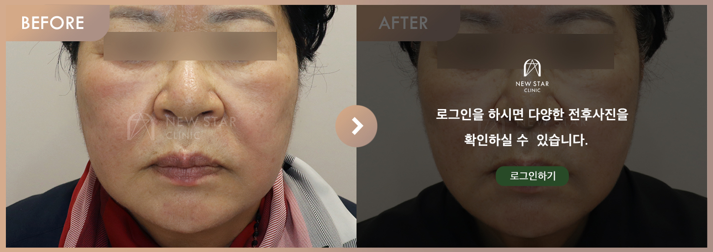 Before & After