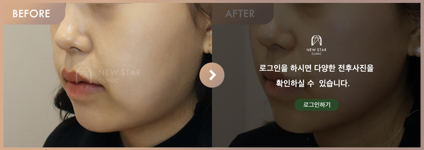 Before & After