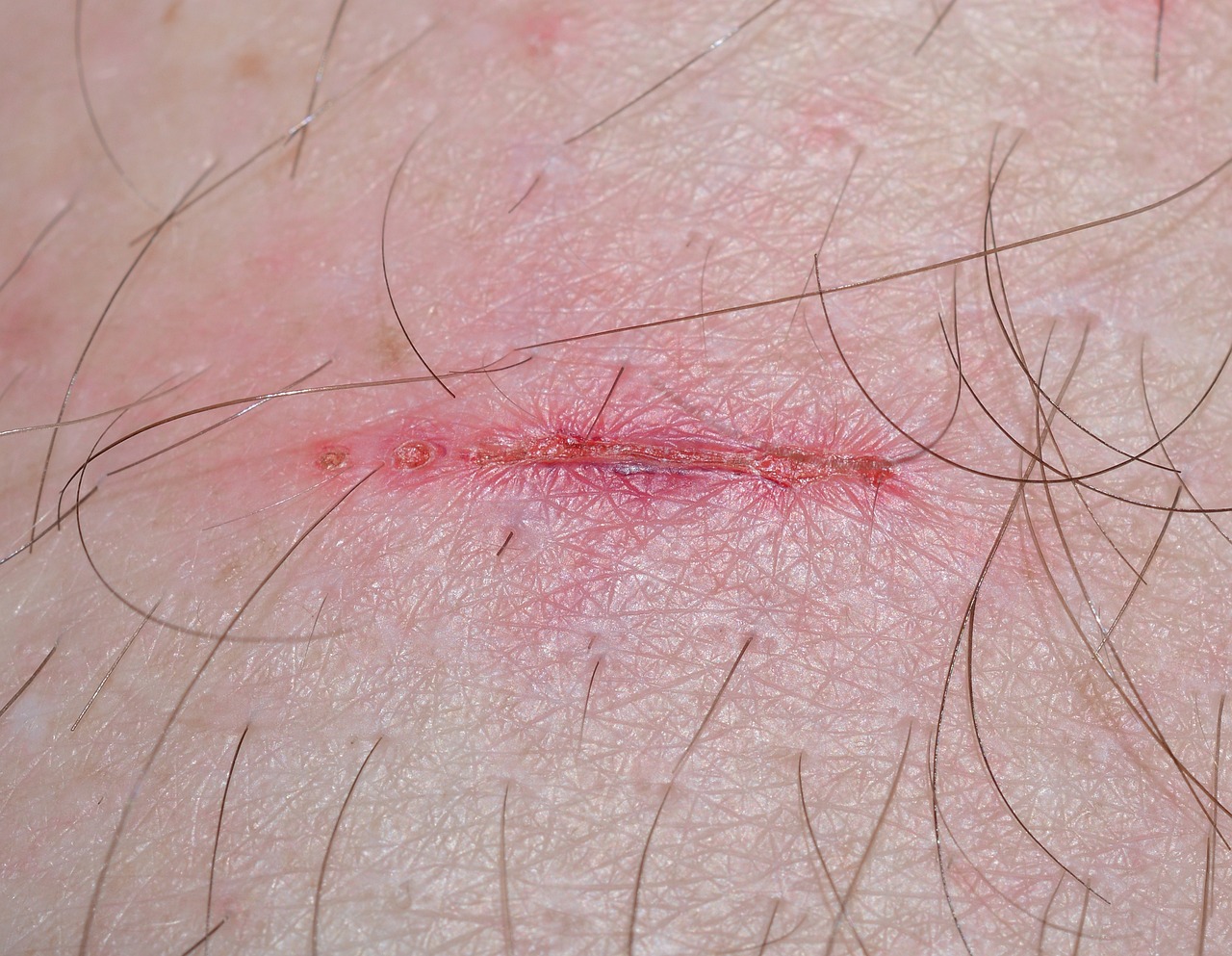 wound-321361_1280 (1)